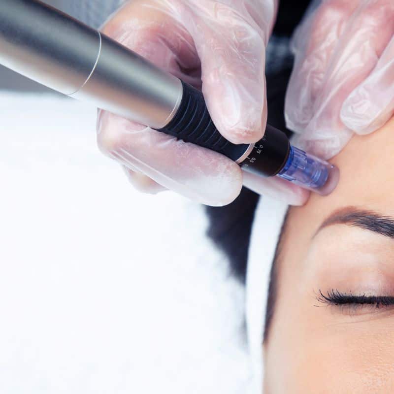 Morpheus8 treatment Old Trafford from Lipo Sculpt - Book in today!
